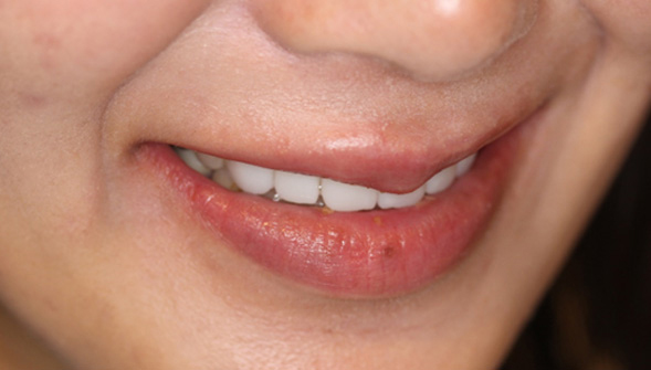 モノリシックジルコニアによる前歯6歯のクラウンの症例