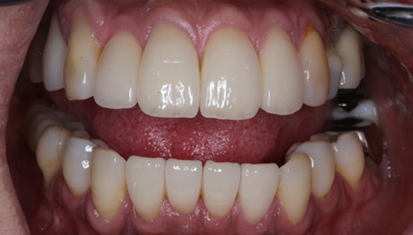 前歯8歯：ポーセレンフューズドジルコニアクラウン