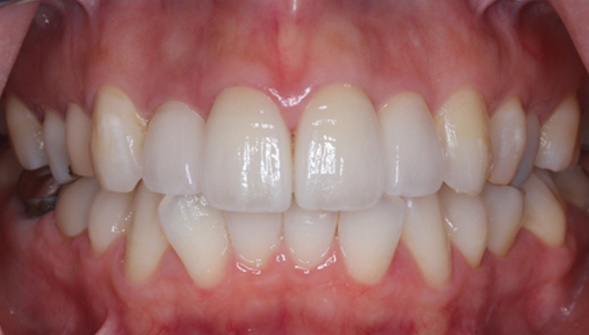 複数の歯のセラミック治療
