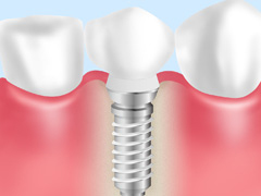 インプラント