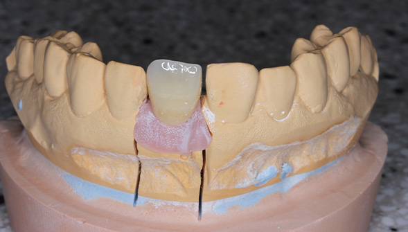 前歯のインプラント：1本の症例