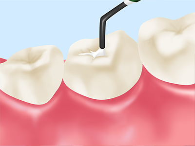 シーラント～奥歯の虫歯予防に～
