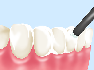フッ素塗布～歯を強くする虫歯予防～