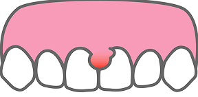 Ｑ．妊娠するとなぜ歯肉炎や歯周病になりやすくなるのですか？