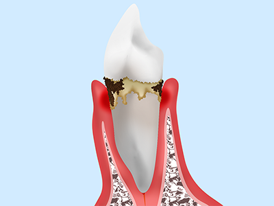 歯周炎(軽度)
