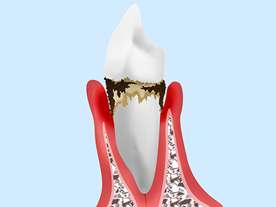 歯周炎(中等度)