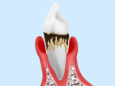 歯周炎(重度)