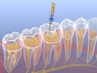 歯の土台を担う根管治療の重要さ