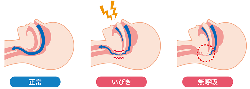 睡眠時無呼吸症候群(Sleep Apnea Syndrome; SAS)とは？