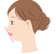 ESアングルが大きい大きいほどSASになりやすく重症度も高くなる傾向