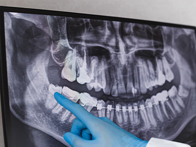 安全で負担の少ない口腔外科治療を実現する3D診断