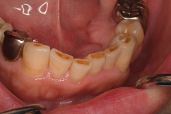 茶色のへこみができる