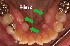 ボコボコともり上がった骨がある