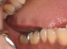 噛みこみの跡がある