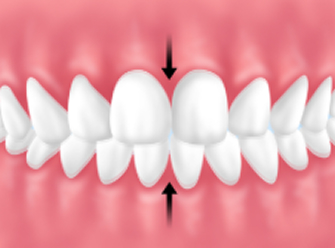 │グラインディング（歯ぎしり）