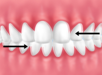 │クレンチング（食いしばり）