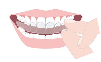 Q . 歯ぎしり食いしばりは治すことができますか？
