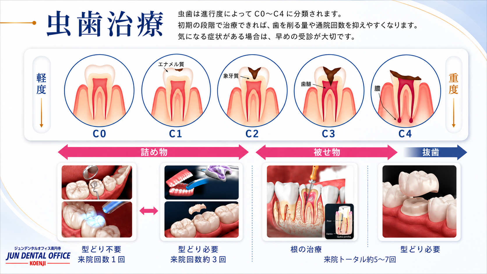 虫歯治療