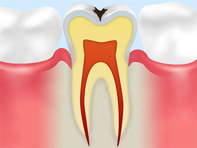 【C1】初期の虫歯
