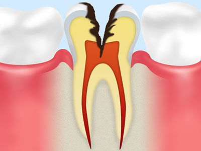 【C3】痛みがある虫歯