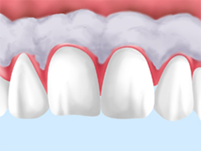 ガムピーリングで「歯茎の黒ずみ」を改善