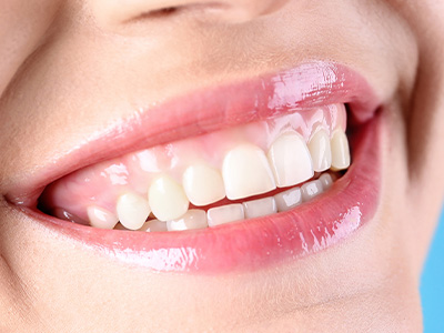 笑ったときに歯茎が目立つ「ガミースマイル」の改善